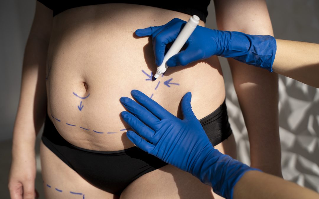 What to Know Before Considering Liposculpture
